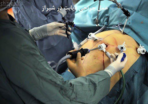 عمل جراحی دیابت در شیراز