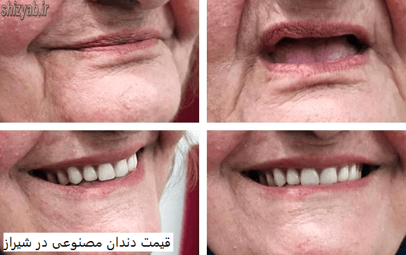 قیمت دندان مصنوعی در شیراز