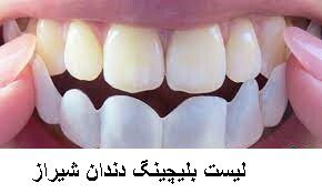 لیست بلیچینگ دندان شیراز