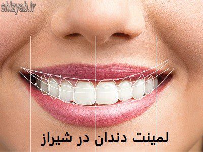 لمینت دندان در شیراز