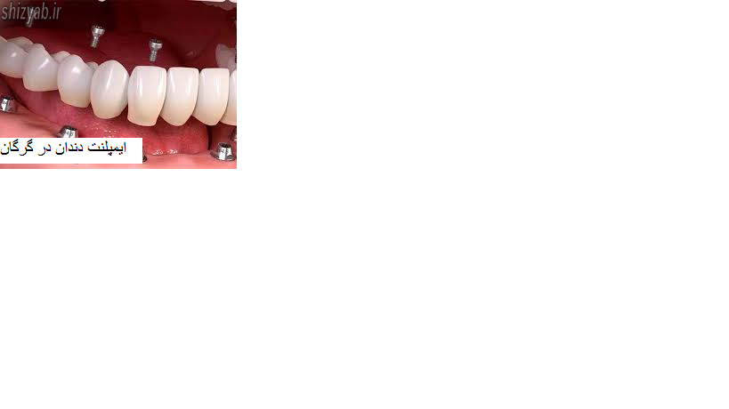 ایمپلنت دندان در گرگان