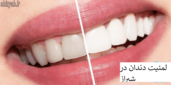 لمینت دندان شیراز