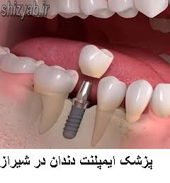 پزشک ایمپلنت دندان در شیراز