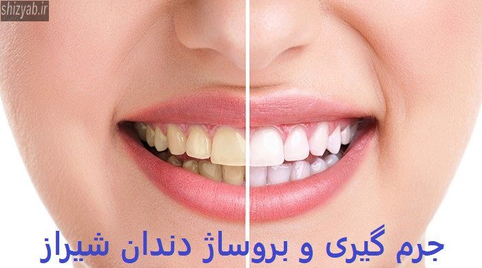 جرم گیری و بروساژ دندان شیراز