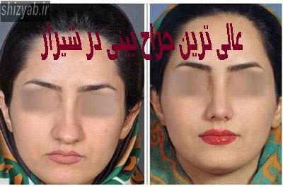 عالی ترین جراح بینی در شیراز