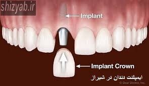 ایمپلنت دندان در شیراز