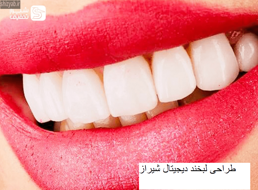 طراحی لبخند دیجیتال شیراز